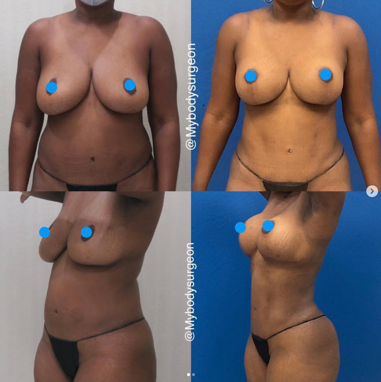 breast lift without scars houston